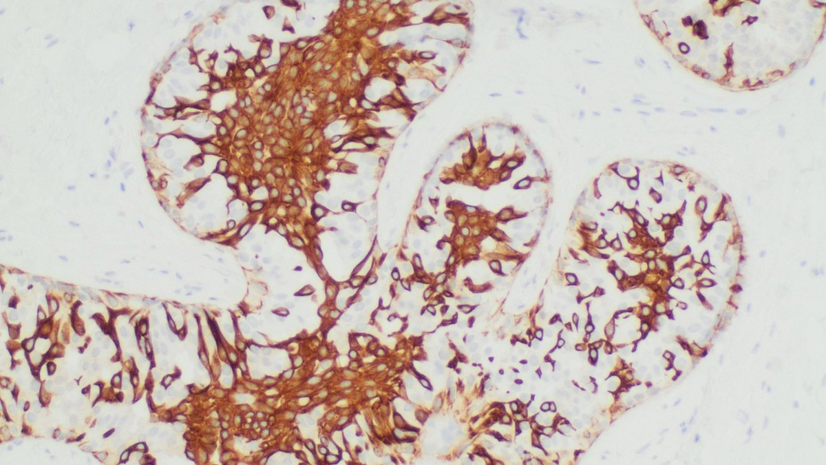 Antibody-based immunohistochemistry: brown DAB staining marks precisely where detection antibodies have bound their target antigen in a tissue section — the specificity that, against donor HLA, produces donor-specific antibodies; a Panacea Bio Chem review by Bogdan Dicoias