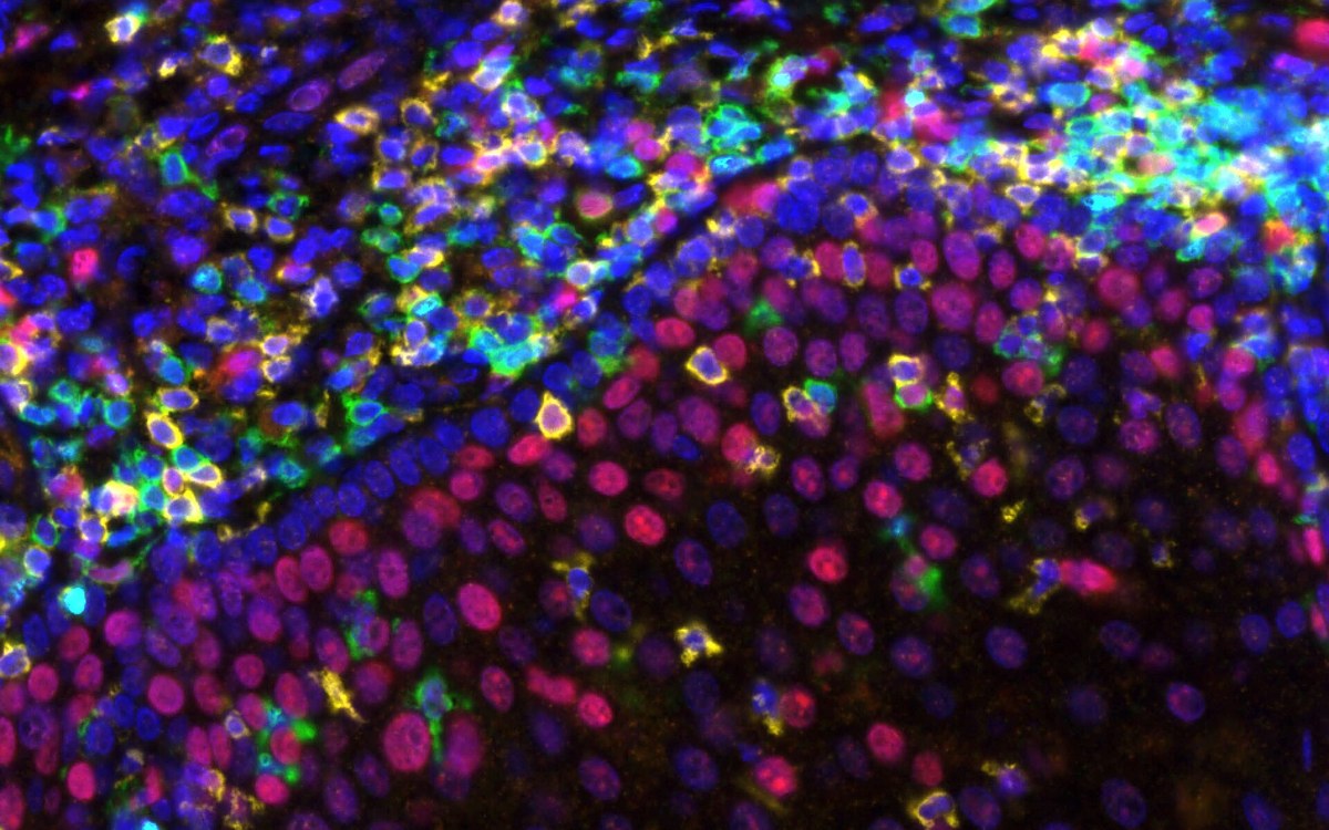 Multicolour immunofluorescence of T cells infiltrating tissue — immune surveillance reading self from altered non-self, a Panacea Bio Chem review by Bogdan Dicoias