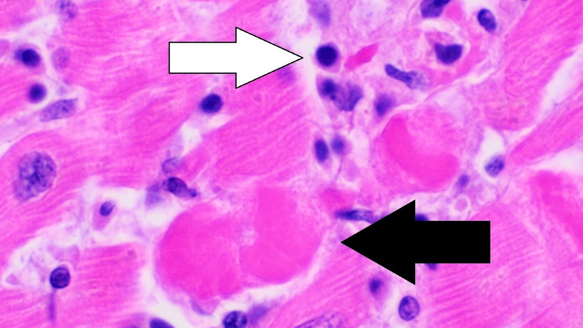Lymphocytes with small dark-stained nuclei infiltrating muscle tissue (arrows) in a stained section — the mononuclear patrol that includes natural killer cells, a Panacea Bio Chem immunology review by Bogdan Dicoias